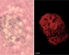 Imaging of cells immunoreactive with polyclonal anti-PS100 antibody in a human liver section invaded by metastatic melanoma