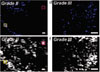 MALDI-MS molecular ion images of selected masses from a distinct pair of progressive meningioma samples