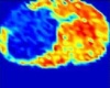 MALDI MSI of tumor