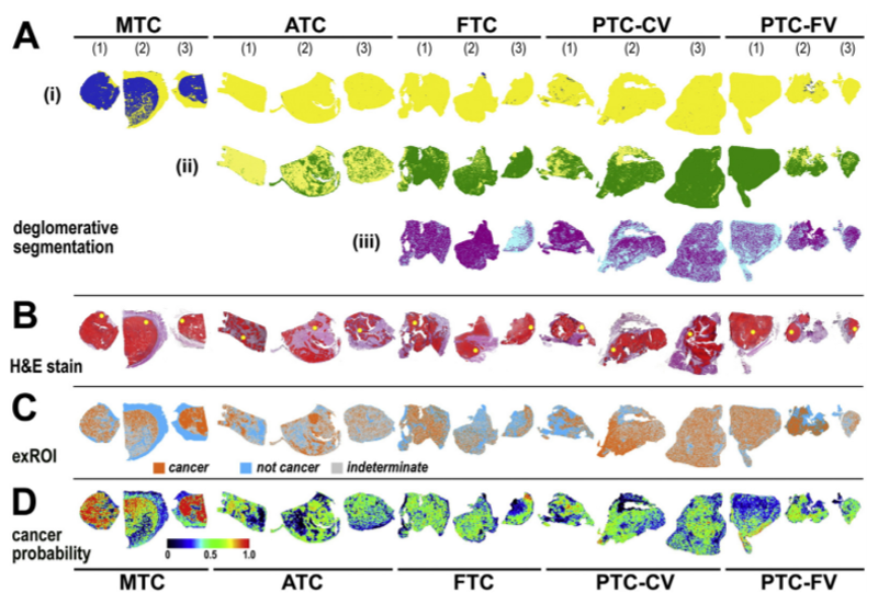 MALDI-MSI analysis of different types of thyroid cancer